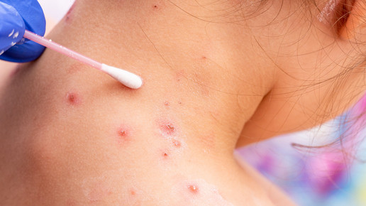 Nach Corona: Wieder mehr Infektionskrankheiten