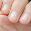 Mythos weißer Fleck: Fingernägel zeigen Mineralstoffstatus Foto: Closeup einer Hand mit weißen Flecken auf den Fingernägeln