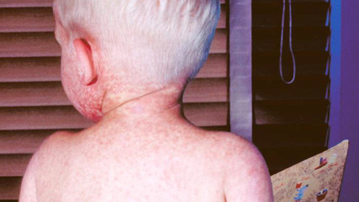 Masernfälle in Europa verdoppelt