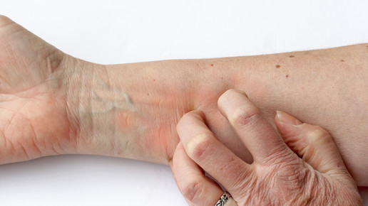 Etokimab gegen Neurodermitis: Erfolg in Phase II