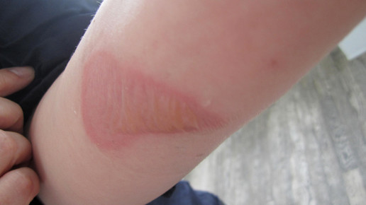 Fresh-up: Verbrennungen