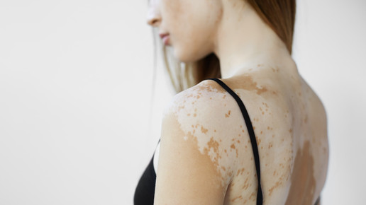 Vitiligo und Akne inversa: BVDD startet Aufklärungskampagne