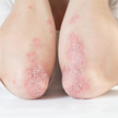 Foto: Psoriasis an den Ellbogen.