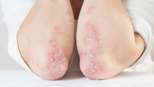 Psoriasis: GLP-1 senkt Sterberisiko und Herzrisiken