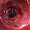 Zeposia: Nächste Indikation Colitis ulcerosa?