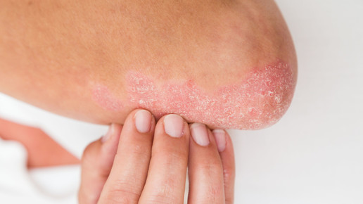 Krebsrisiko Schuppenflechte?