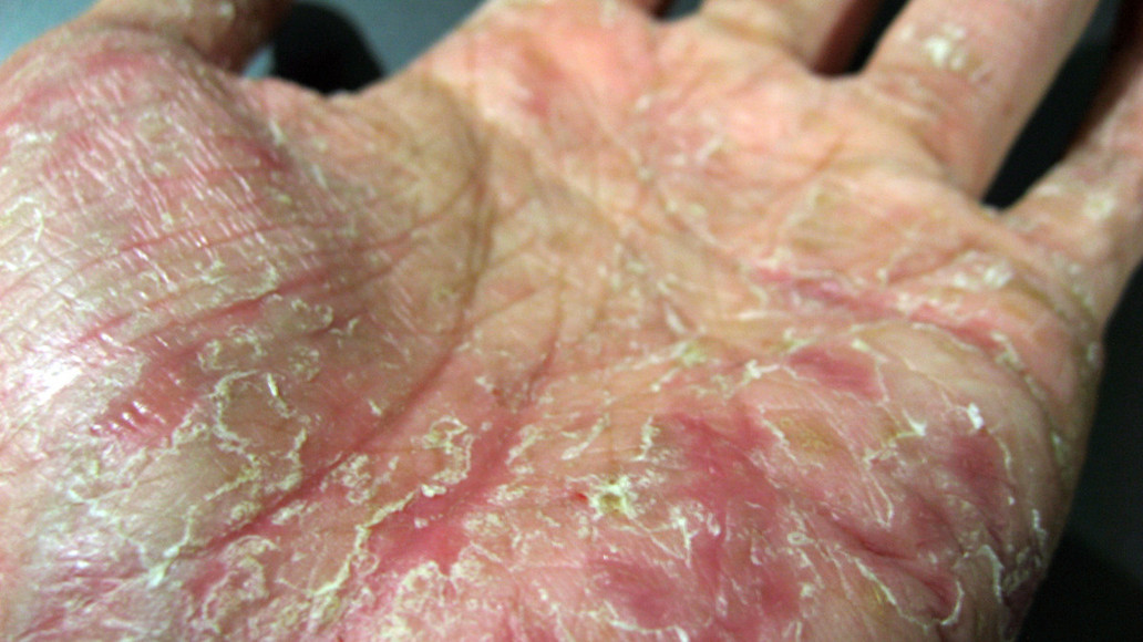 Chronisches Handekzem Besser desinfizieren als waschen APOTHEKE ADHOC