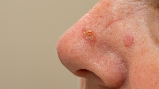 Aktinische Keratose: Das ist topisch möglich