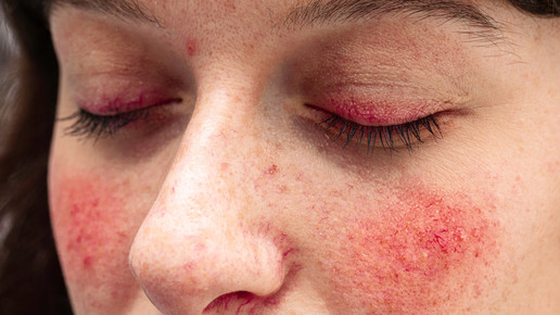 Rosazea: Wie können Rötungen & Pusteln behandelt werden?