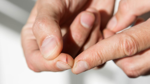 Schmerzhafte Hautrisse mit Sekundenkleber heilen