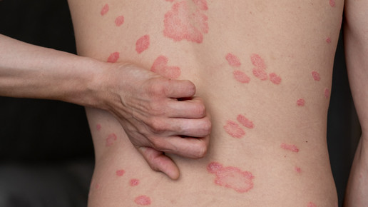 Betamethason/Salicylsäure: Klinge zieht nach