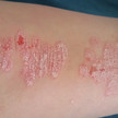 Fresh-up: Psoriasis
