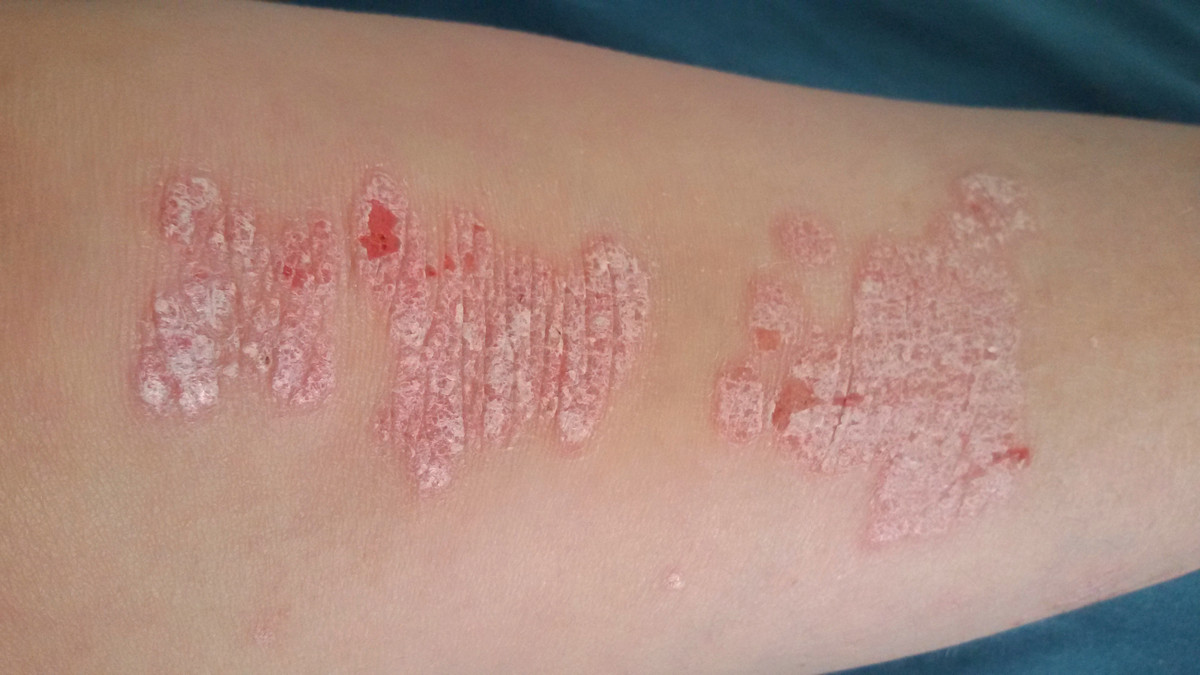 Freshup Psoriasis APOTHEKE ADHOC