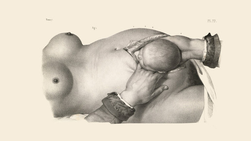 victorian kaiserschnitt 01 wellcomecollection