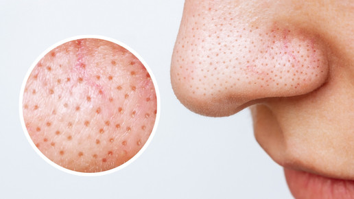 Talgfilamente: Was taugen die Trends?