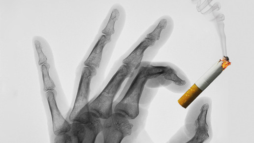 zigarette hand roentgen bernd kasper pixelio