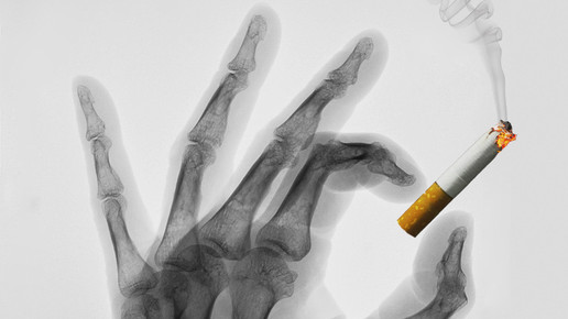 zigarette hand roentgen bernd kasper pixelio