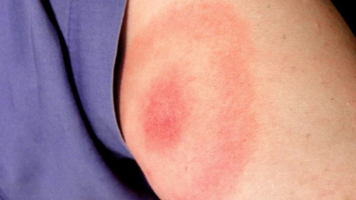 Borreliose-Impfung: Positive Studienergebnisse