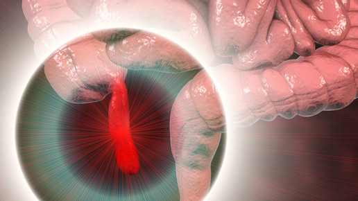 Covid-19 kann zu Blinddarmentzündung führen