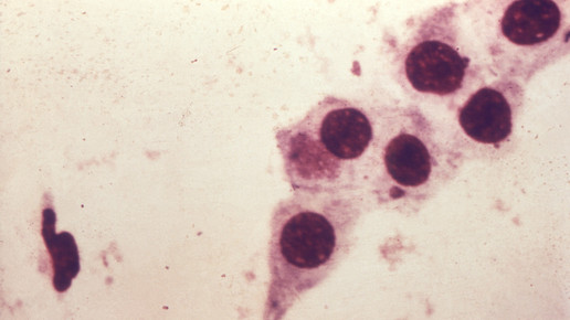 Chlamydia trachomatis CDC Dr Wiesner Dr Kaufman