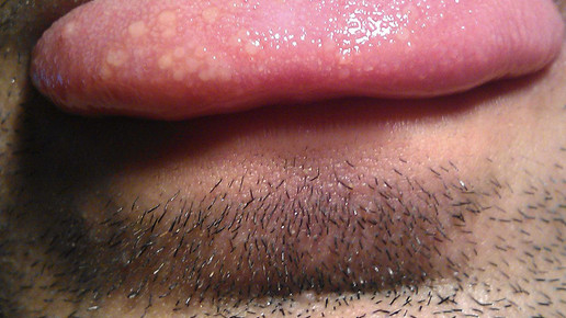 aphthe zunge wiki prochoma ccbysa30