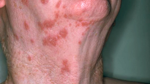 ausschlag gesicht hals  NIAID