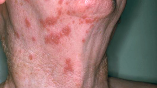 ausschlag gesicht hals  NIAID