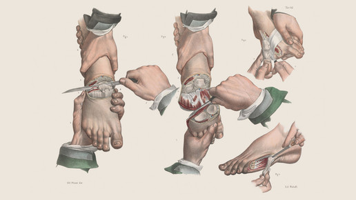 victorian fuss amputation wellcomecollection