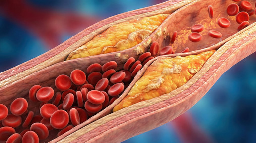 Neuer Wirkstoff gegen LDL-Cholesterin