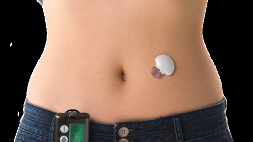 medtronic guardian medtronic