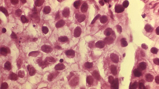 Magnet-Roboter macht Hoffnung gegen Krebs