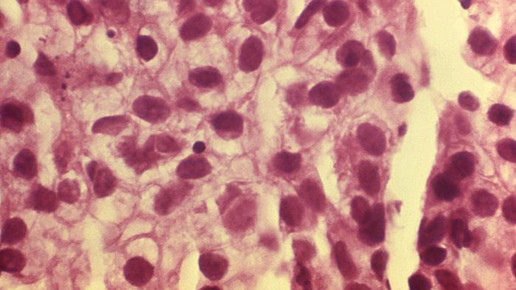 cancer krebs CDC a elizabeth plott CT ASCP