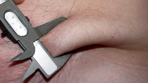 adipositas uebergewicht dieter schuetz pixelio de