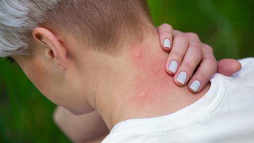 Mückenstich: Kratzen verboten!