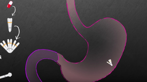 sternkapsel video magen scs