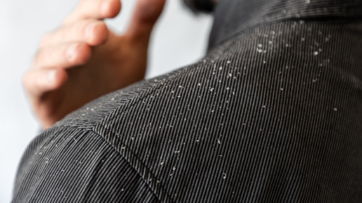 Foto: Eine männliche Person mit Kopfhautschuppen auf der Schulter.