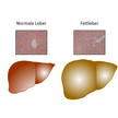 Auslöser für Fettleber entdeckt Auslöser für Fettleber entdeckt