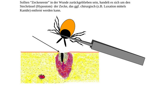160614 zecke entfernung5 lglbayern