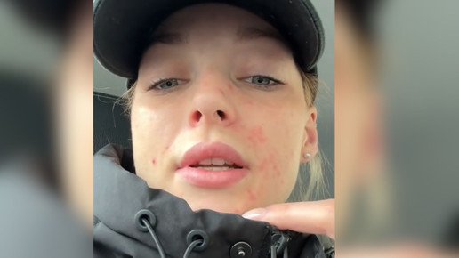 Herpes: „Vertraue Apotheker mehr als dem Arzt“
