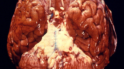 cdc meningitis hirn cdc