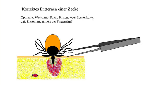 160614 zecke entfernung1 lglbayern