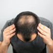 Foto: Ein Mann mit kreisrundem Haarausfall