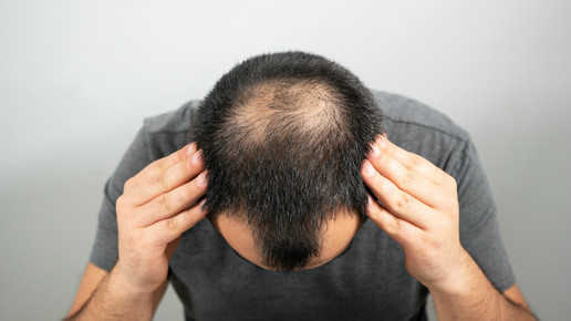 Minoxidil-Wirkung: Plateau nach sechs Monaten