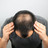Foto: Ein Mann mit kreisrundem Haarausfall