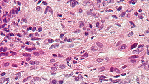 primaere biliaerer Zirrhose leber wiki nephron ccbysa30