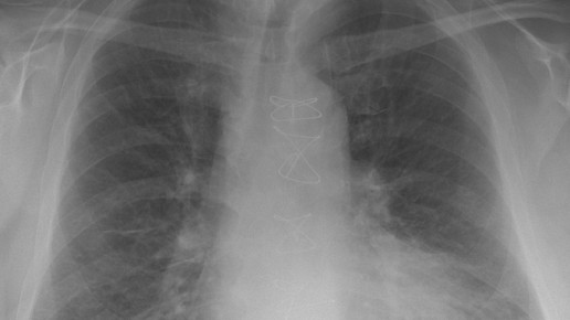 herzinsuffizienz braegel cc-by sa3.0