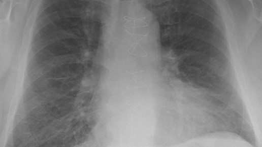 herzinsuffizienz braegel cc-by sa3.0