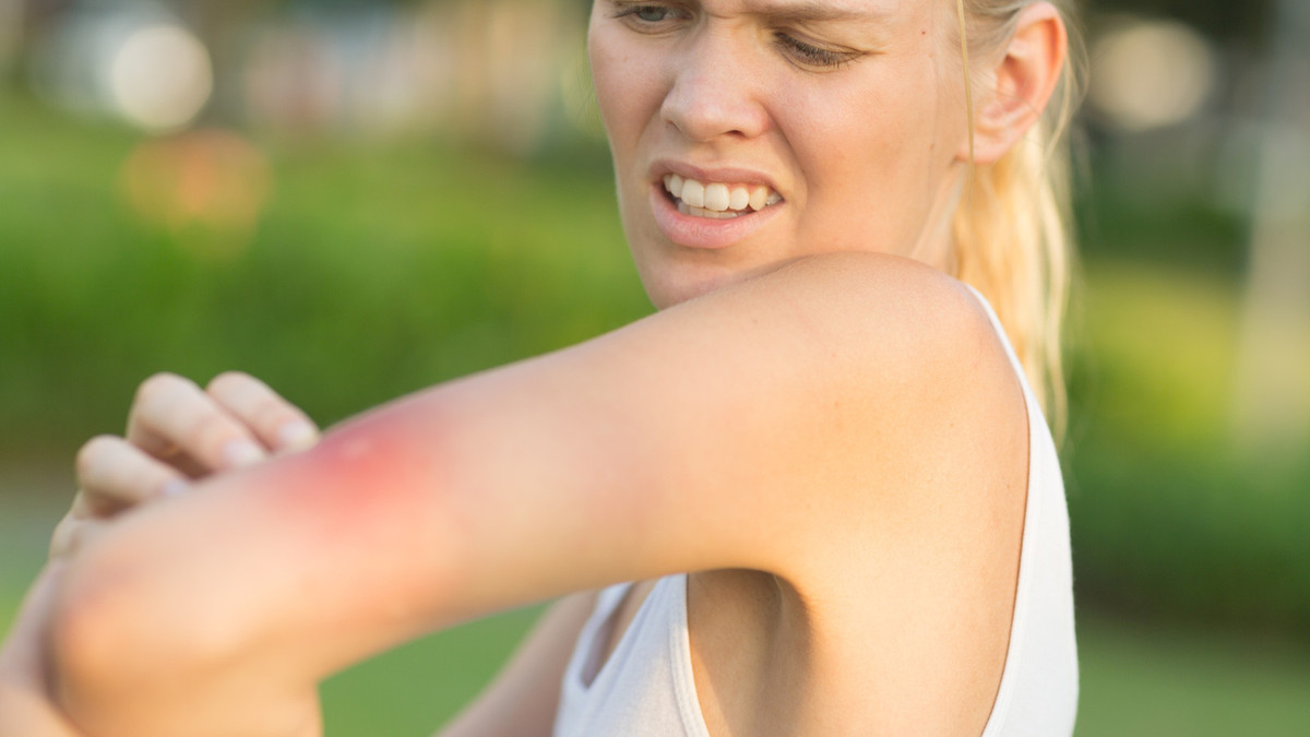 Kriebelmücken Schmerzhafte und eiternde Stiche APOTHEKE ADHOC