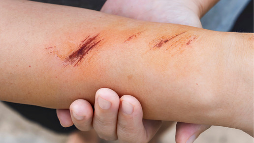 Wundbehandlung: Versorgungschaos geht in die nächste Runde