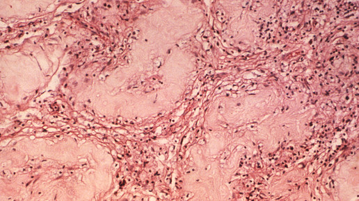 lepra cdc drandrejlebrun